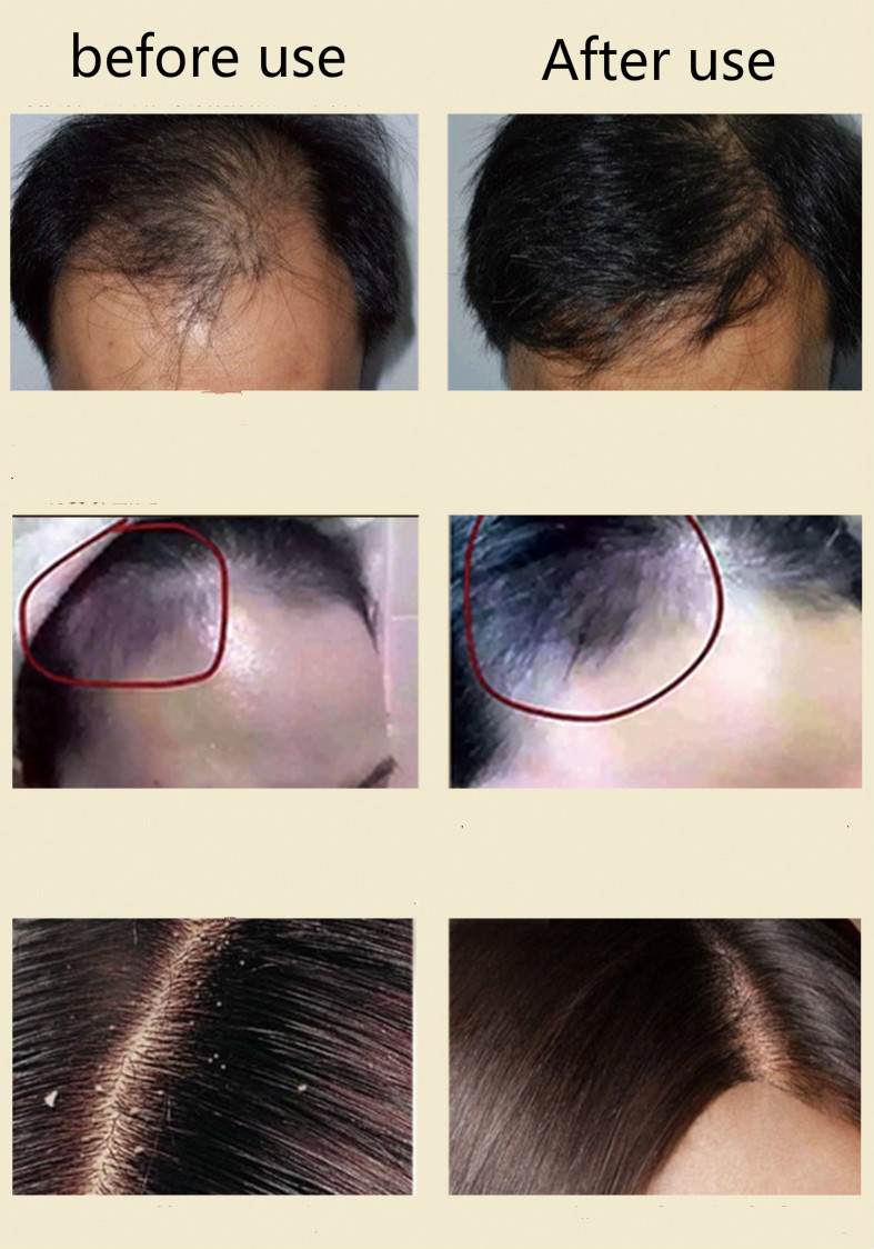 Buy Anti Hair Removal Hair Shampoo Plant Ingredients Anti Defix
